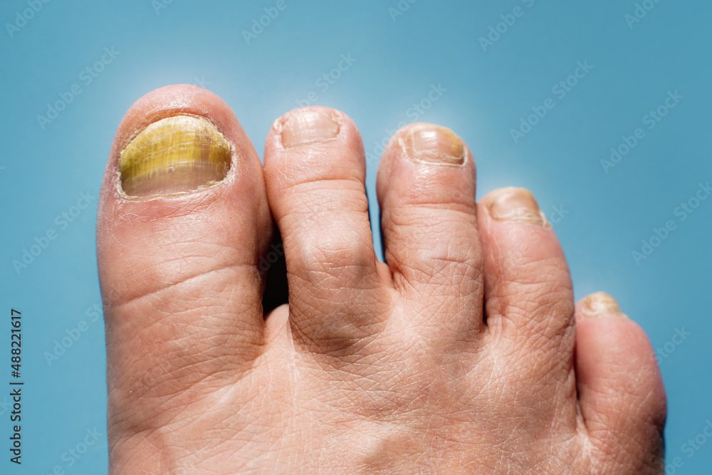 Toenail fungus